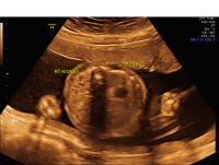 Unilateral renal agenesis axial